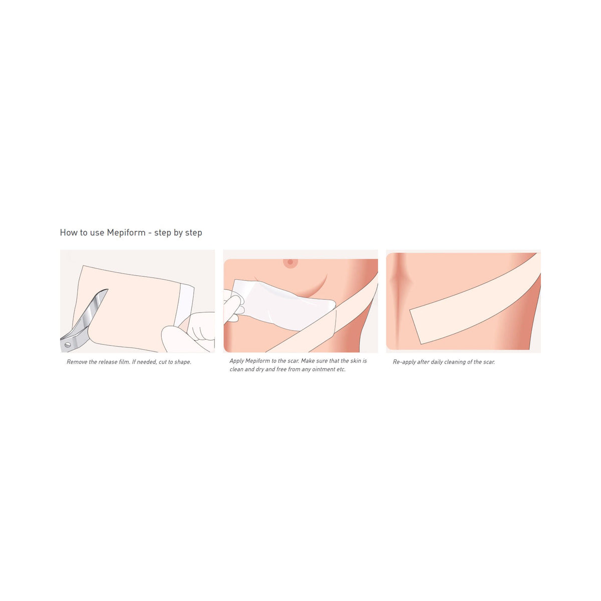 Mepiform® Self Adherent Silicone Dressings Dressing
